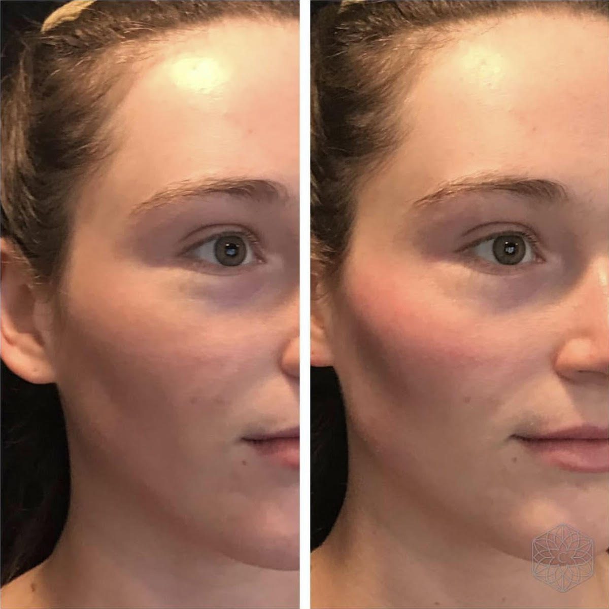 tear trough filler before and after